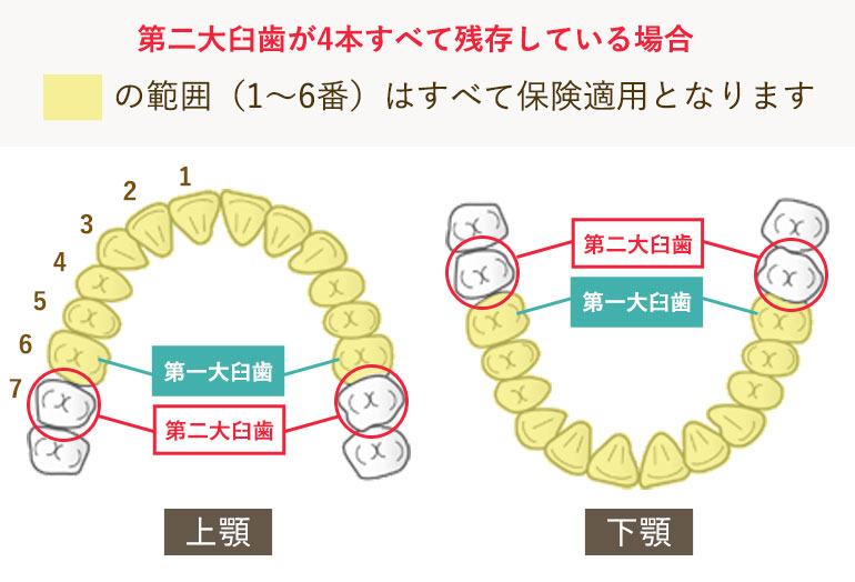 CAD/CAM冠