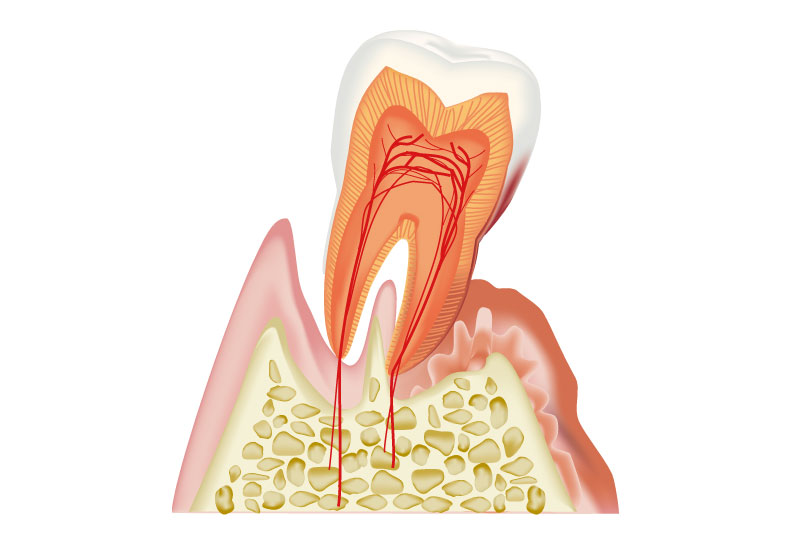 歯周病治療