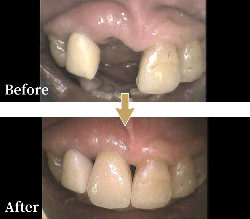 インプラント症例1