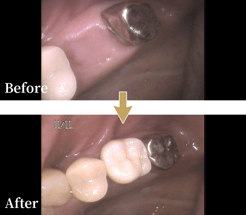 インプラント症例2